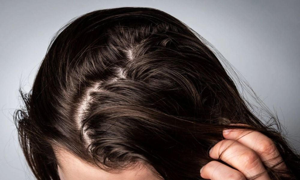 hair care chemicals - greasy-hair