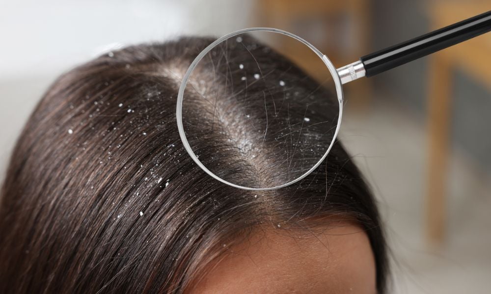 hair care chemicals - should-wash-hair-often-with-dandruff