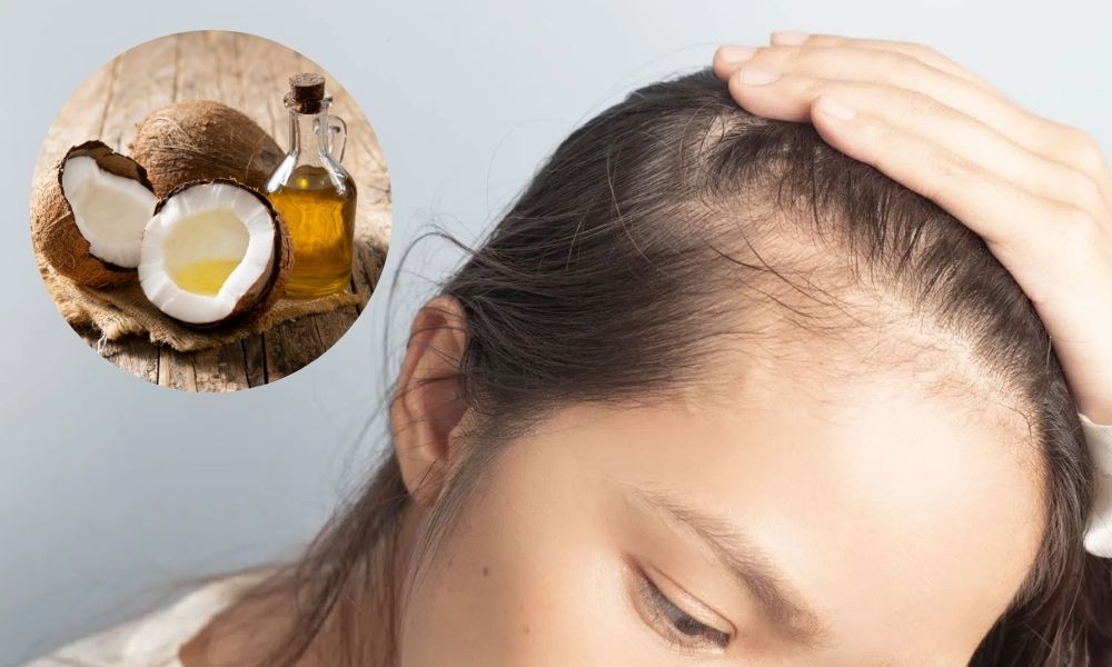 Dầu dừa là nguyên liệu giúp cải thiện tình trạng tóc bò liếm hiệu quả
