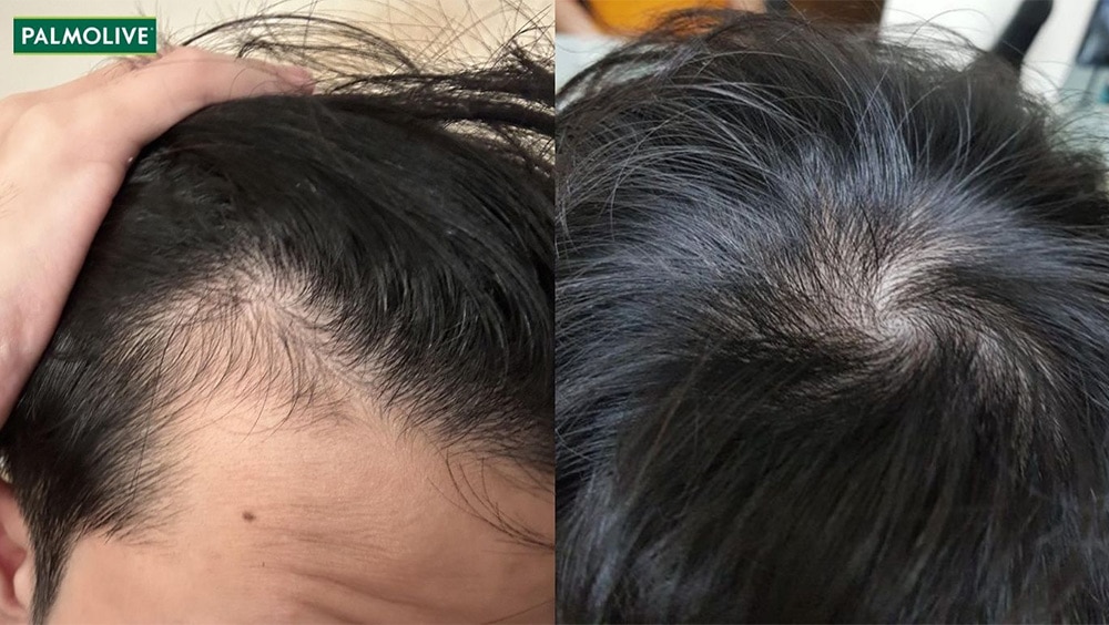 Hình ảnh minh họa tình trạng tóc bị bò liếm ở vùng trán và xoáy đỉnh đầu