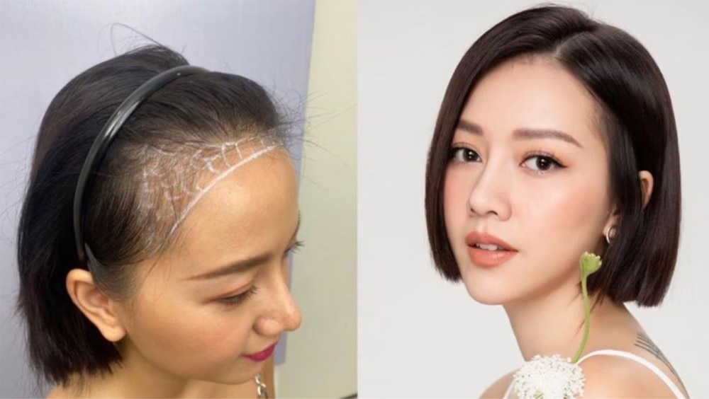 Cải thiện tóc bị bò liếm bằng cấy tóc tự thân