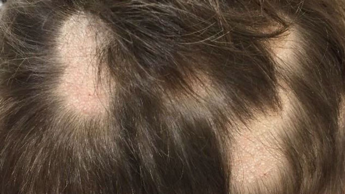 Chăm sóc da đầu khỏe mạnh là một bước quan trọng để hạn chế gãy rụng tóc