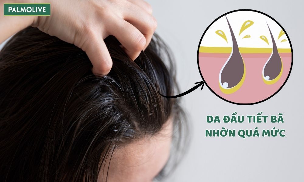 Tóc dầu là tình trạng tóc nhanh bết do tuyến bã nhờn hoạt động mạnh