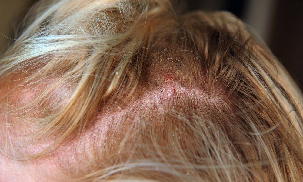 Bệnh lý da đầu có thể gây ngứa và khó chịu sau khi gội đầu