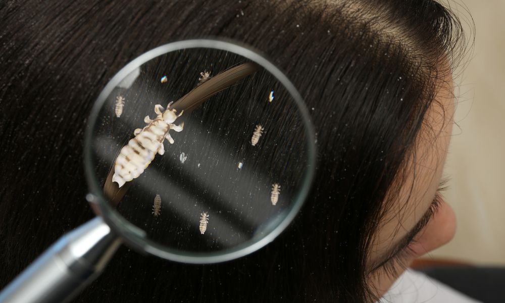 Chấy và trứng chấy là nguyên nhân gây ngứa dai dẳng trên da đầu