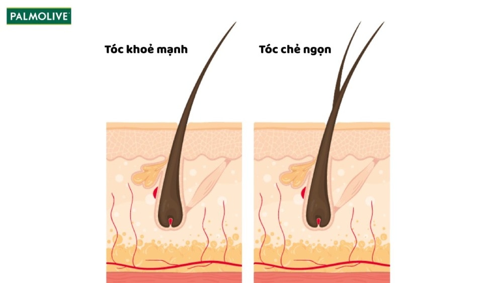 Giải thích tóc chẻ ngọn là gì