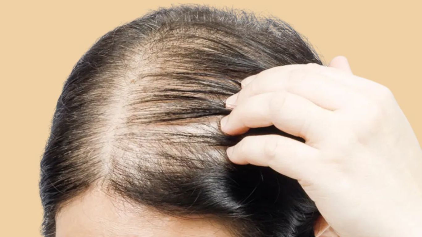 Tóc mỏng thưa do di truyền