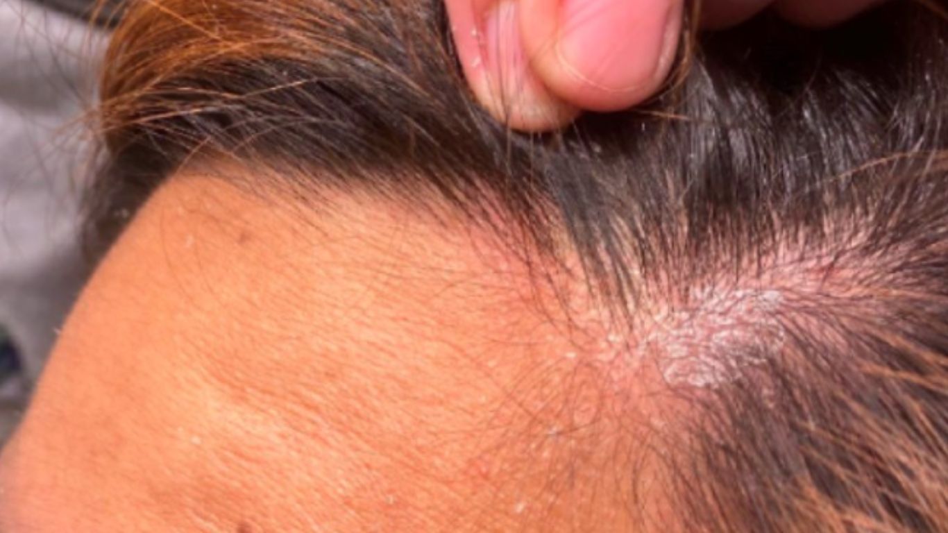 Tóc mỏng thưa do nấm da đầu