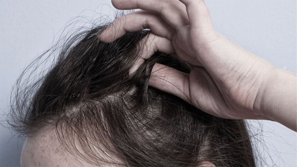 Tình trạng ngứa da đầu do áp lực tâm lý kéo dài