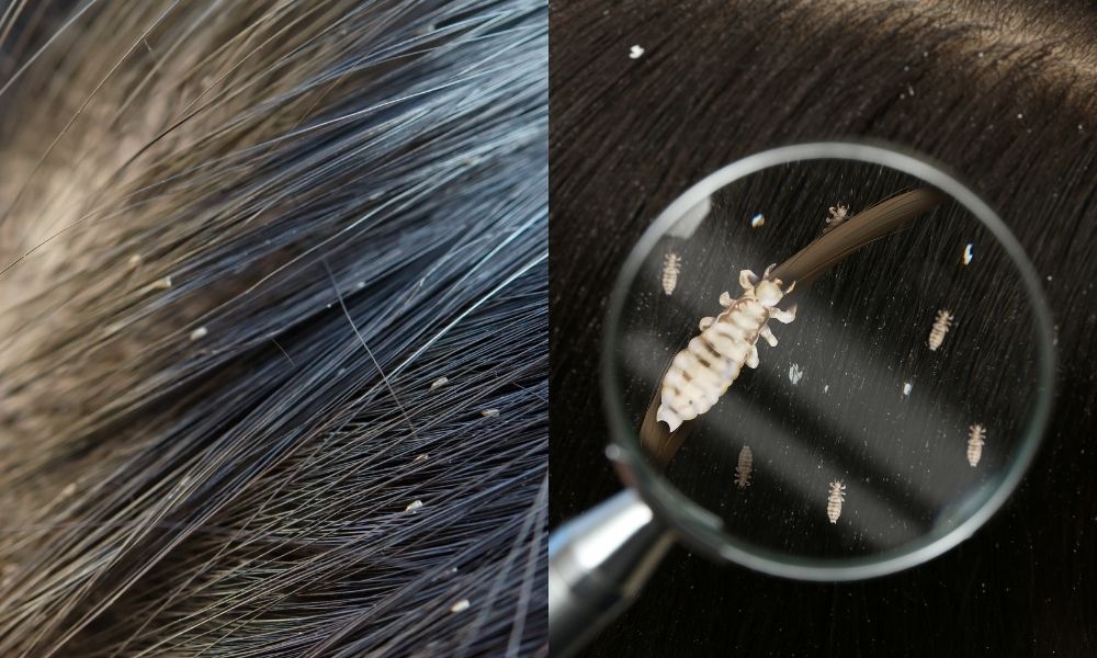 hair care chemicals - does-hair-straightening-remove-lice-1 Cảm giác ngứa da đầu là dấu hiệu để nhận biết có chấy trên da đầu