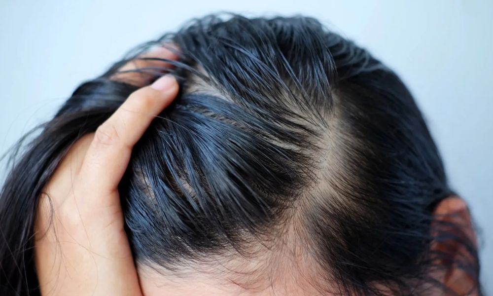Bết tóc do thường xuyên chạm vào tóc Bết tóc do thường xuyên chạm vào tóc