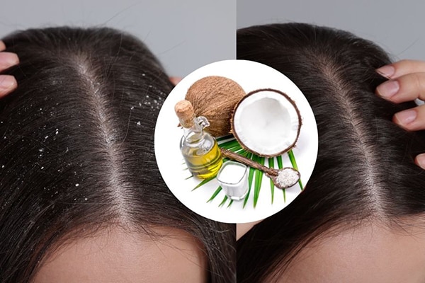 Dầu dừa giúp loại bỏ gàu và bảo vệ da đầu một cách hiệu quả Dầu dừa giúp loại bỏ gàu và bảo vệ da đầu một cách hiệu quả