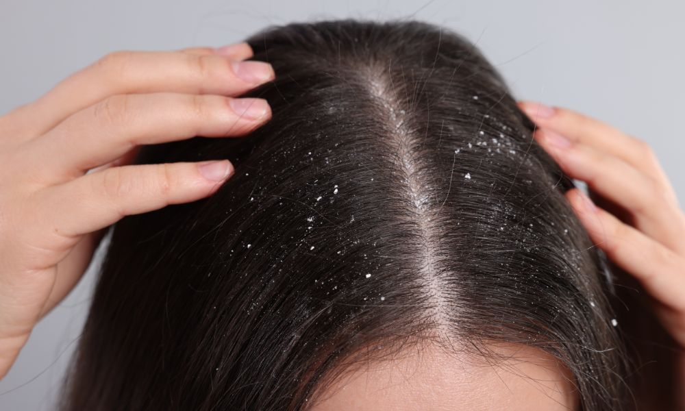 hair care chemicals - should-wash-hair-often-with-dandruff-1 bị gàu có nên gội đầu nhiều